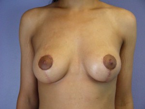 Breast Lift with Augmentation