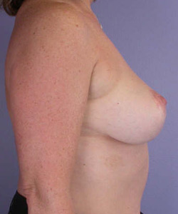 Breast Lift with Augmentation