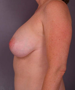 Breast Lift with Augmentation