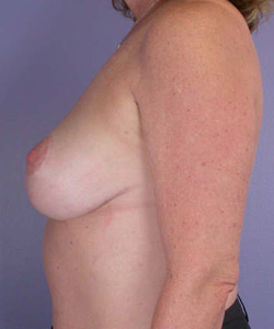 Breast Lift with Augmentation