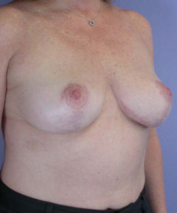 Breast Lift with Augmentation