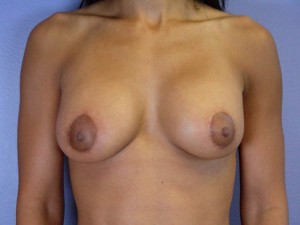 Breast Lift with Augmentation