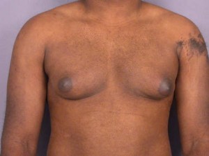 Breast Reduction (for Men)