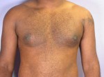 Breast Reduction (for Men)