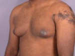 Breast Reduction (for Men)