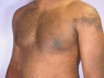 Breast Reduction (for Men)