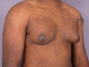 Breast Reduction (for Men)