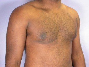 Breast Reduction (for Men)