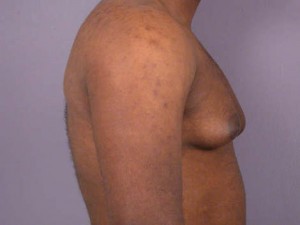 Breast Reduction (for Men)