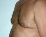 Breast Reduction (for Men)