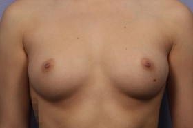 Breast Augmentation