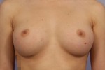 Breast Augmentation