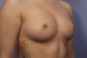 Breast Augmentation