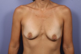 Breast Augmentation