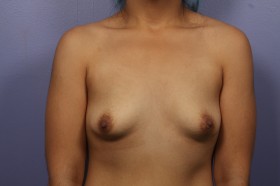 Breast Augmentation