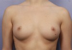 Breast Augmentation