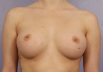 Breast Augmentation