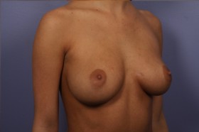 Breast Augmentation