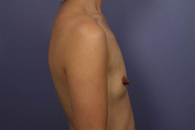 Breast Augmentation