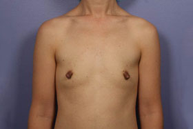 Breast Augmentation