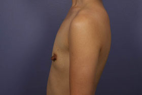 Breast Augmentation