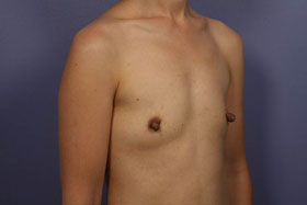 Breast Augmentation