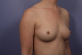 Breast Augmentation