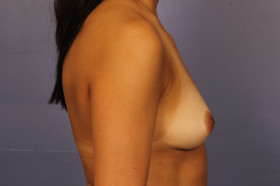 Breast Augmentation