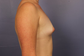 Breast Augmentation