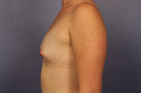 Breast Augmentation