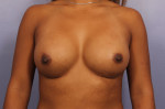 Breast Augmentation