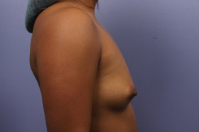 Breast Augmentation