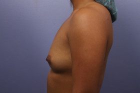 Breast Augmentation