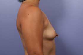 Breast Augmentation