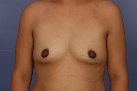 Breast Augmentation