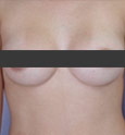 after breast augmentation