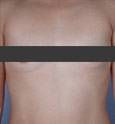 before breast augmentation